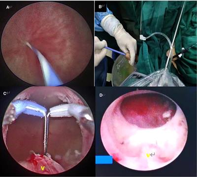 Transurethral Incision of the Bladder Neck at Three Points with a Needle-Type Electrode for Bladder Neck Contracture